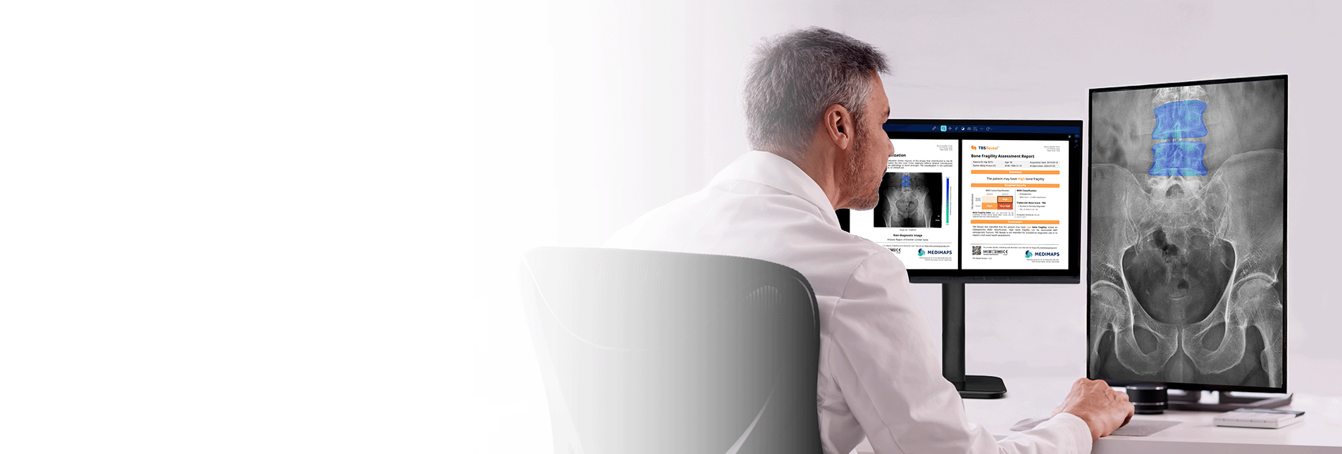 TBS Reveal* is designed to help close this gap by detecting fragility earlier, directly from routine X-rays.